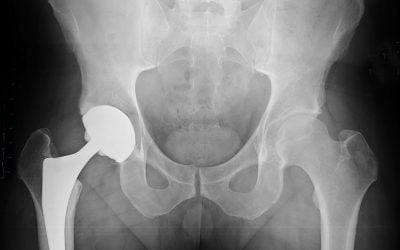 Replacement Body Parts