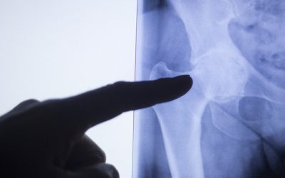 Hip or Back Pain? How Do You Know?