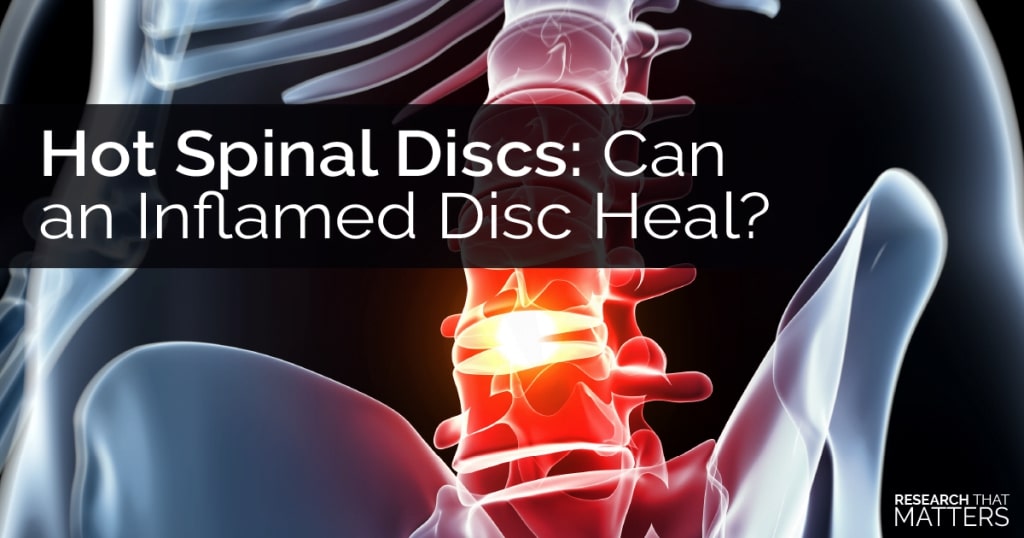 Hot Spinal Discs